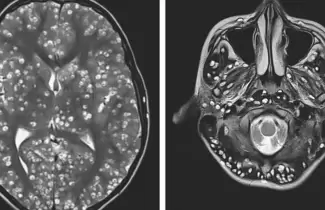 cerebro