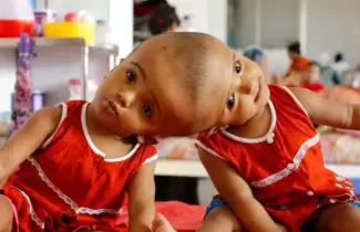 bebes-siamesas