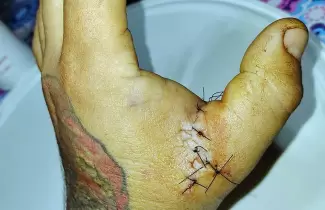mano-herida-tatuador