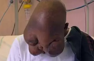 joven-tumor-