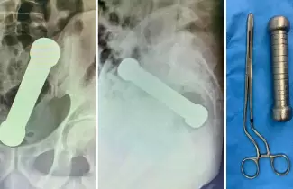 mancuerna-operacion-hombre