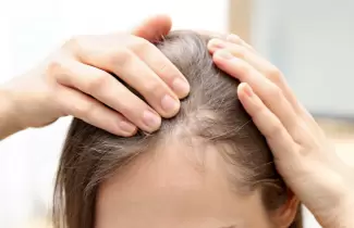 alopecia