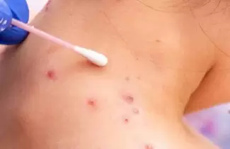 viruela-del-mono-casos