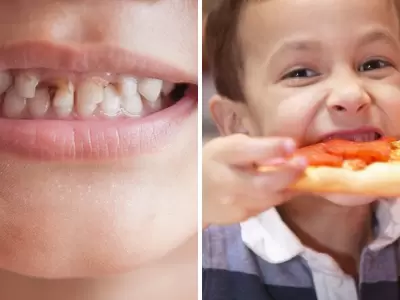 Caries y obesidad