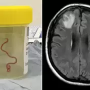 Una mujer sufrió síntomas por años hasta que descubrieron que tenía un gusano vivo en el cerebro