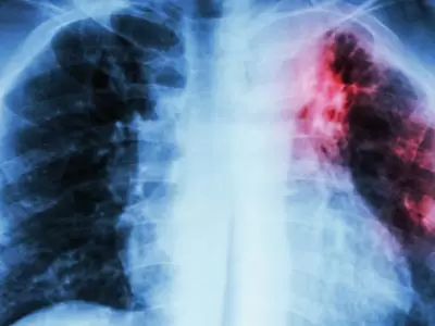 Tuberculosis