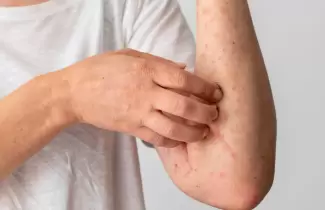 sarampi�n