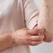 Salta registra m�s de 130 casos de varicela y refuerzan medidas de prevenci�n